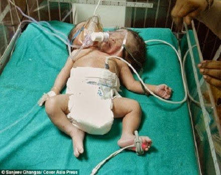 Woman Gives Birth To Baby With 2 Heads, 2 Spines, 2 Necks 634
